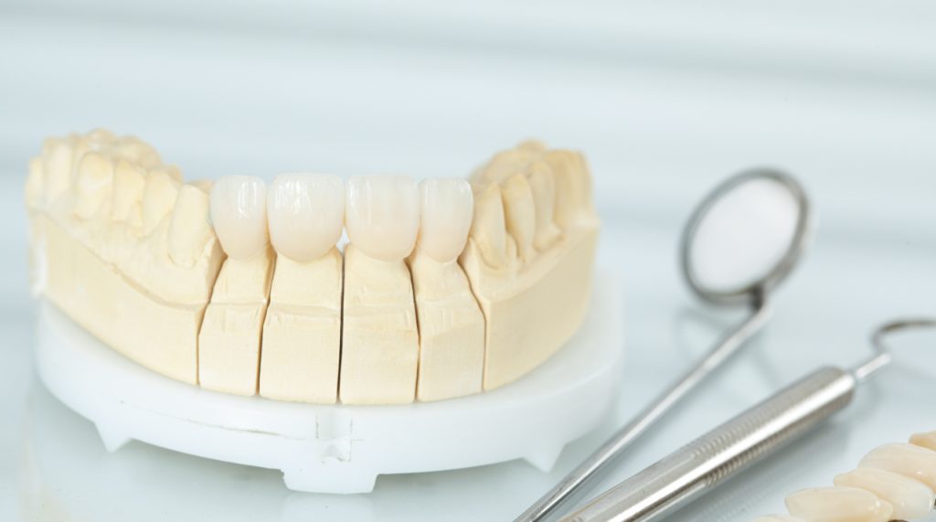 Dental-Veneers-in-Clute-texas-1024x571